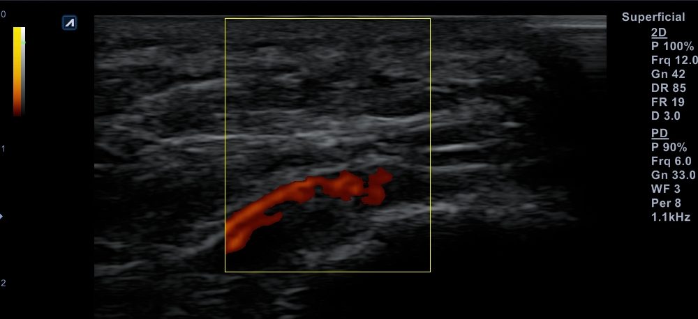 Peesaandoeningen - Fysiotherapie in Hoorn | GC Nieuwe Steen